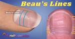 Beau's Lines: Uncover the Meaning of Horizontal Nail Ridges