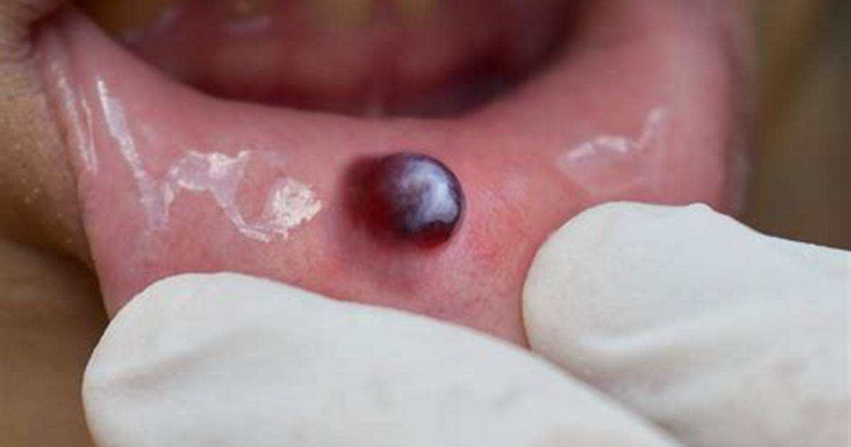 Blood Blisters on Roof of Mouth: Causes, Symptoms, and Treatment