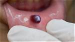 Blood Blisters on Roof of Mouth: Causes, Symptoms, and Treatment