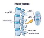 Discover Advanced Facet Arthrosis Treatment Options for Lasting Relief