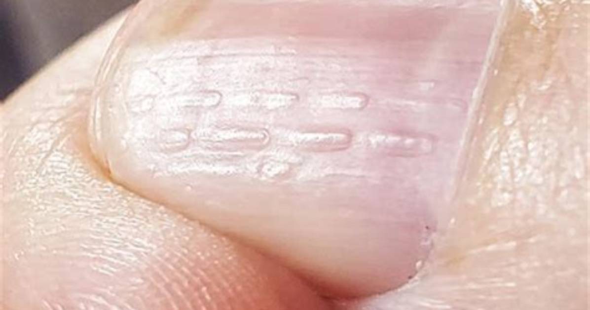 Discover the Meaning Behind Horizontal Nail Ridges: a Guide to Nail Health
