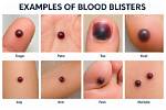 Discover the Root Causes of Blood Blisters in Your Mouth