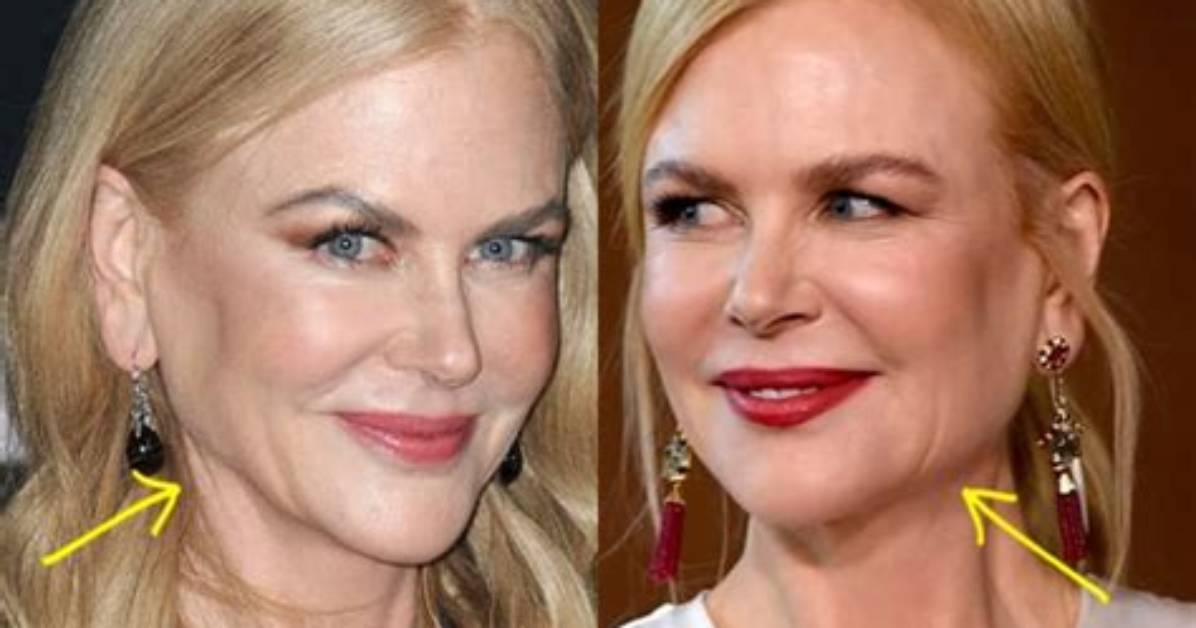 Dr Nicole Kidman's Facelift - Did She Get It?
