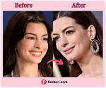 Has She Done Jaw Surgery and Botox ·