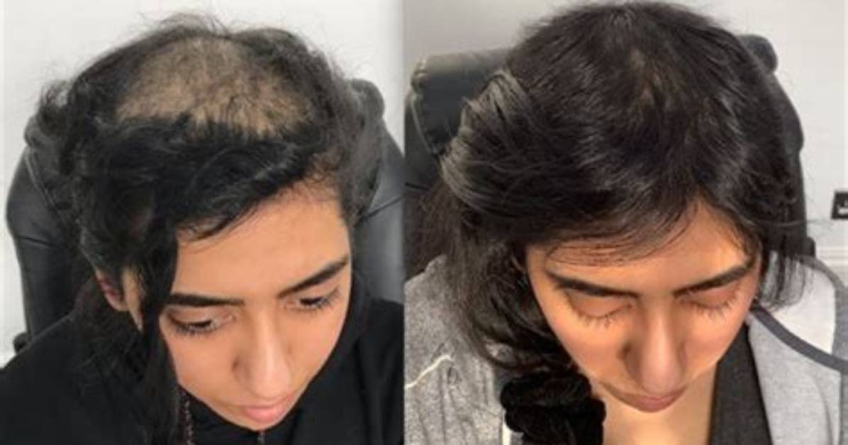 Jordan Walsh Bald: Astonishing Hair Loss Journey of the Rising Star