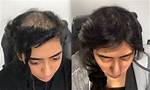 Jordan Walsh Bald: Astonishing Hair Loss Journey of the Rising Star