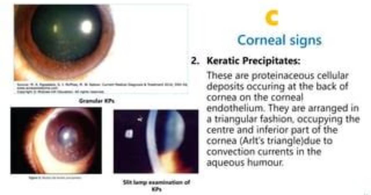 Keratic Precipitates: a Comprehensive Guide to Diagnosis and Management