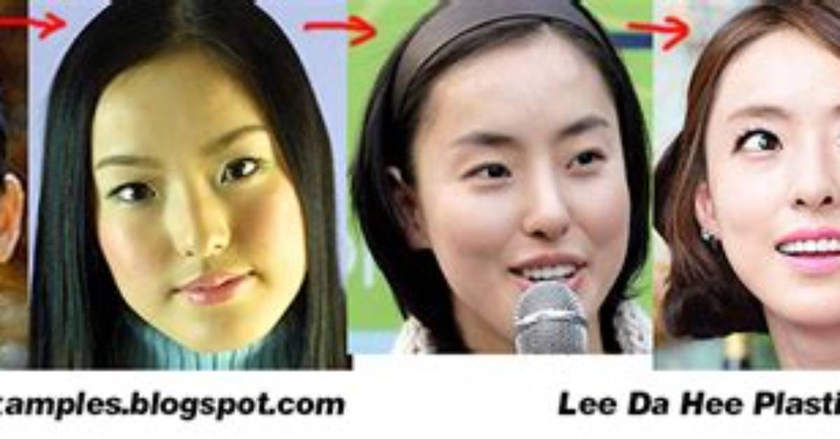 Lee Da Hee Plastic Surgery Before and After: What Is Wrong?