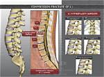[Location] T12 Vertebra Fracture: Causes, Symptoms, and Treatment Options