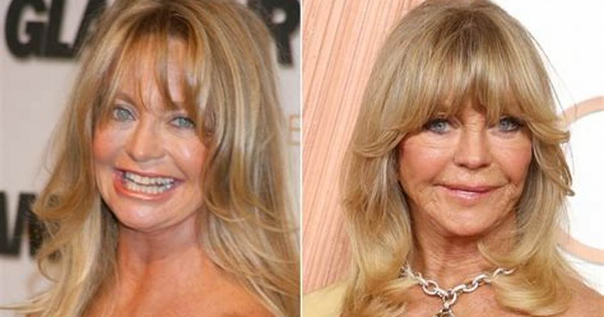 Plastic Surgery Speculations: Examining Goldie Hawn's Transformation