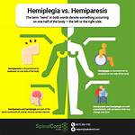Right-Sided Hemiparesis: Causes, Symptoms, and Treatment