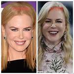 The Truth Behind Nicole Kidman's Plastic Surgery: Fact or Fiction?