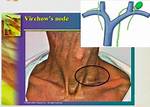 The Truth: Is Virchow's Node Always Cancerous?