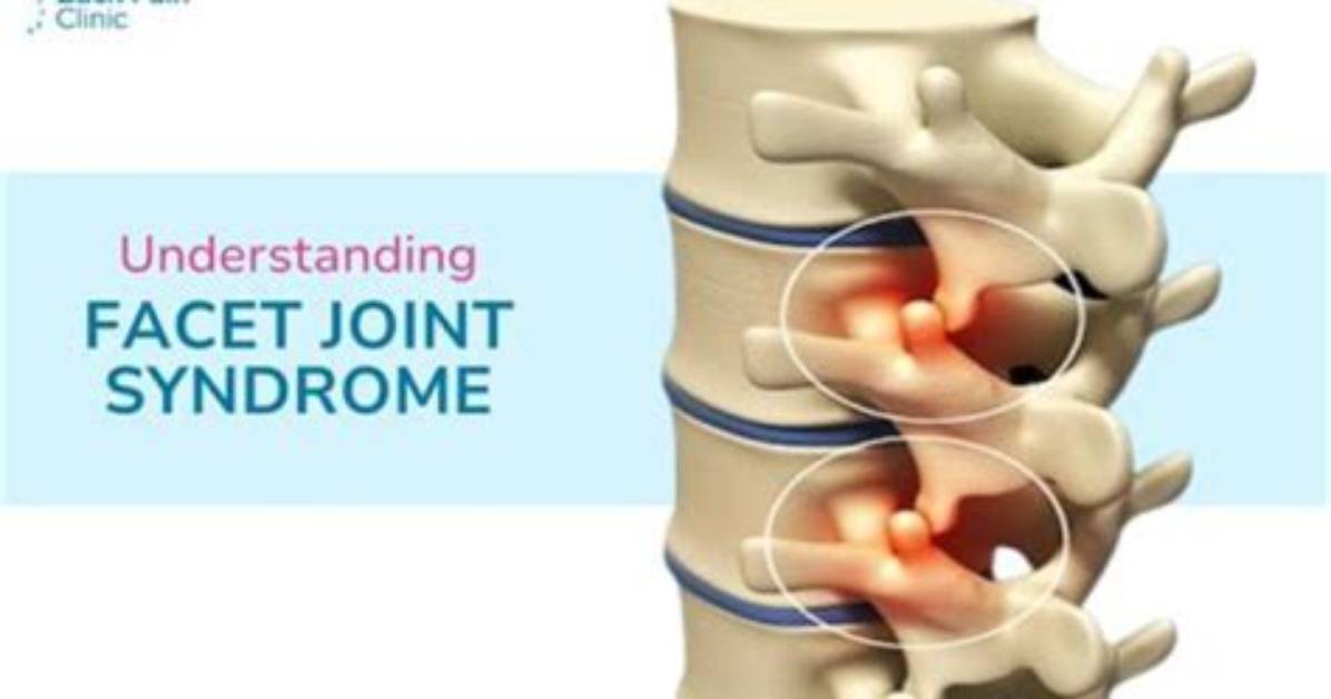 The Ultimate Guide to Facet Arthropathy: Definition, Symptoms, and Treatment