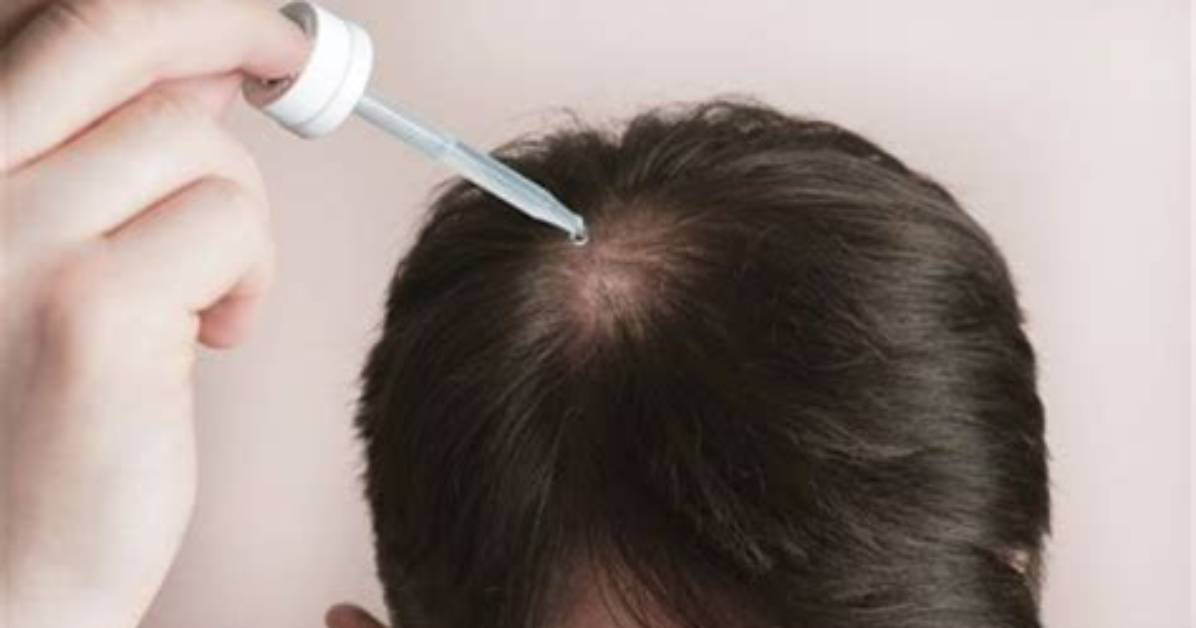 The Ultimate Guide to Gasly Hairlines: Causes, Treatments, and Prevention