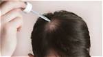 The Ultimate Guide to Gasly Hairlines: Causes, Treatments, and Prevention