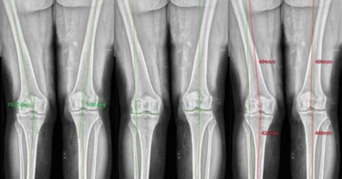The Ultimate Guide to Leg Proportions: Achieving Perfect Symmetry