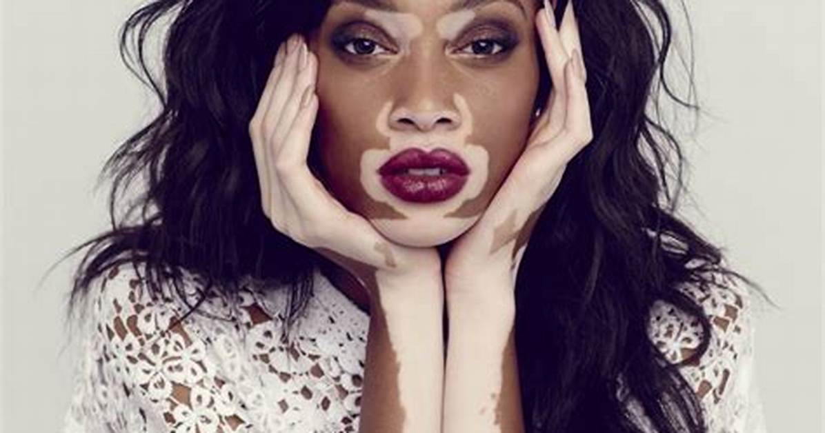 Top Vitiligo Model [Vitiligo Model Name] | Inspiring Beauty