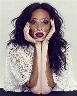 Top Vitiligo Model [Vitiligo Model Name] | Inspiring Beauty