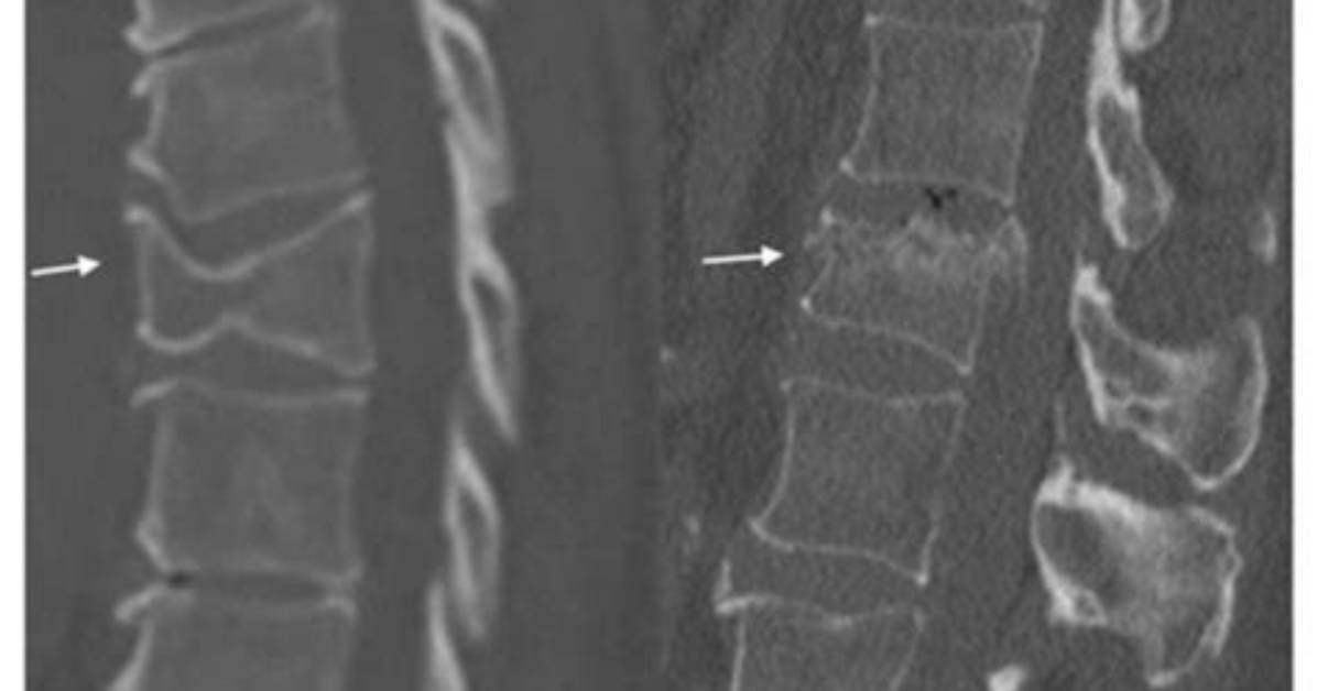 Ultimate Guide to Understanding T12 Fractures
