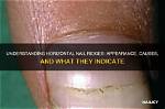 Uncover the Causes Behind Horizontal Nail Ridges: a Comprehensive Guide