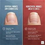 Uncovering the Secrets: Horizontal Ridges in Fingernails Unveiled