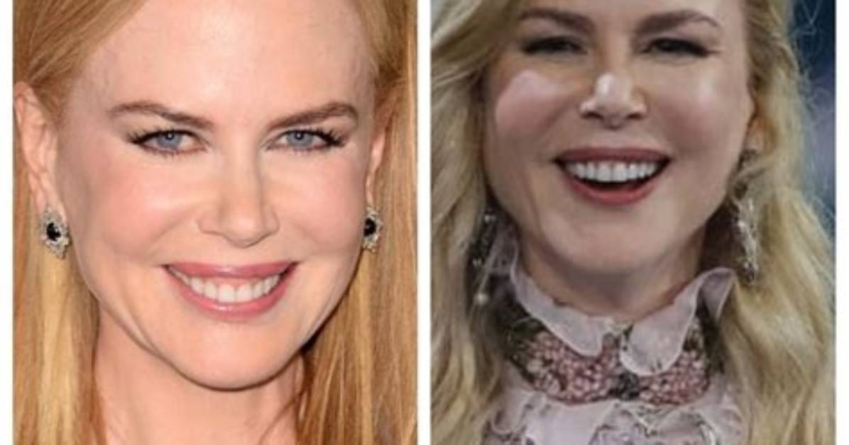 Uncovering the Truth Behind Nicole Kidman's Alleged Surgeries