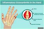 Understanding Hypertrophic Joints: Causes, Symptoms, and Treatment