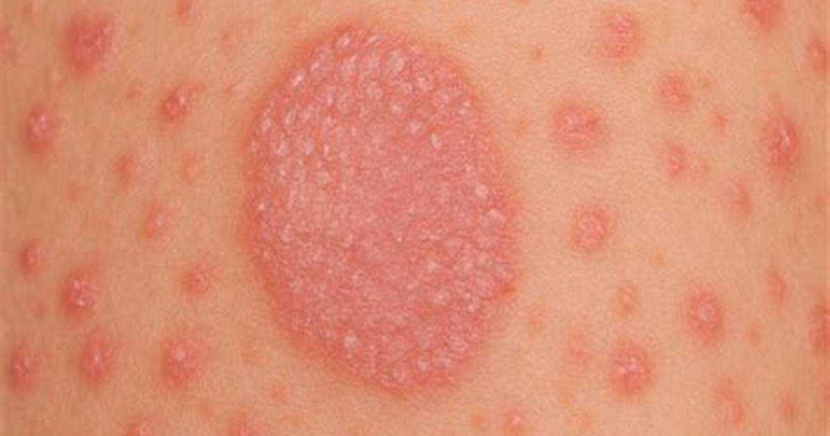 Unveiling the Duration of Pityriasis Rosea: a Comprehensive Guide