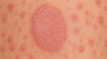 Unveiling the Duration of Pityriasis Rosea: a Comprehensive Guide