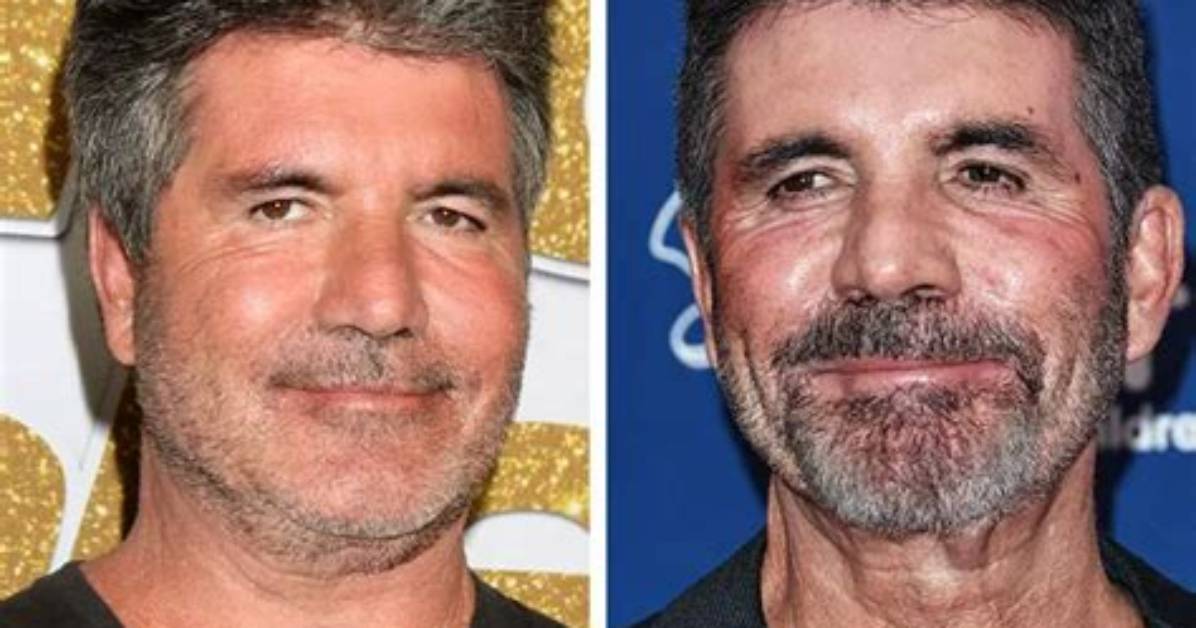 Unveiling the Transformation: Simon Cowell's Pre-Botox Era