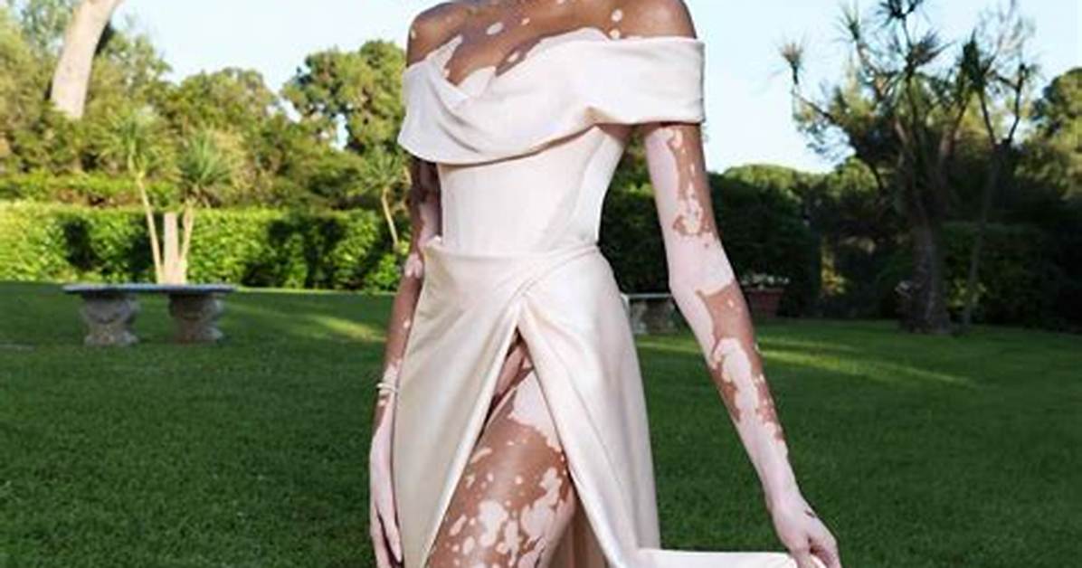 Winnie Harlow: a Model's Fortune Explored