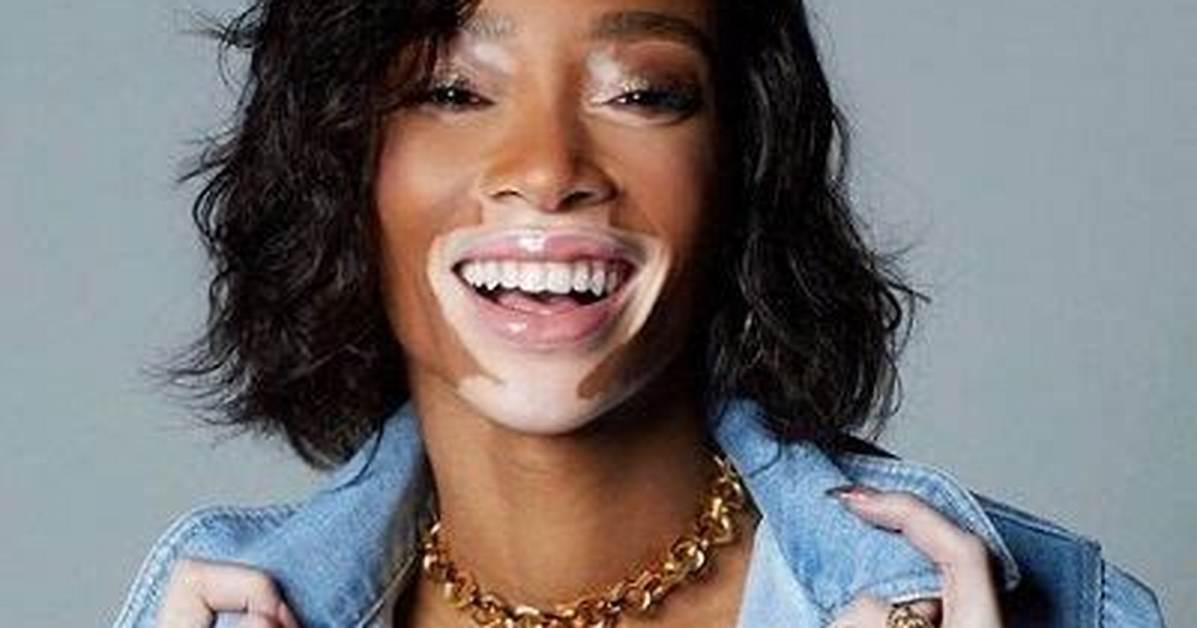 Winnie Harlow's Age: How Old Is the Canadian Model and Activist?